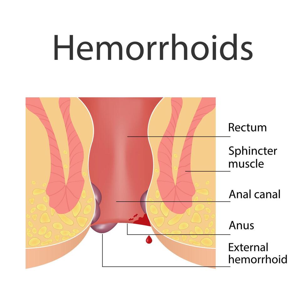 Hemorrhoids and inflammation cause bleeding through the patient's fistula. Cross-section of the rectum and anal canal vector