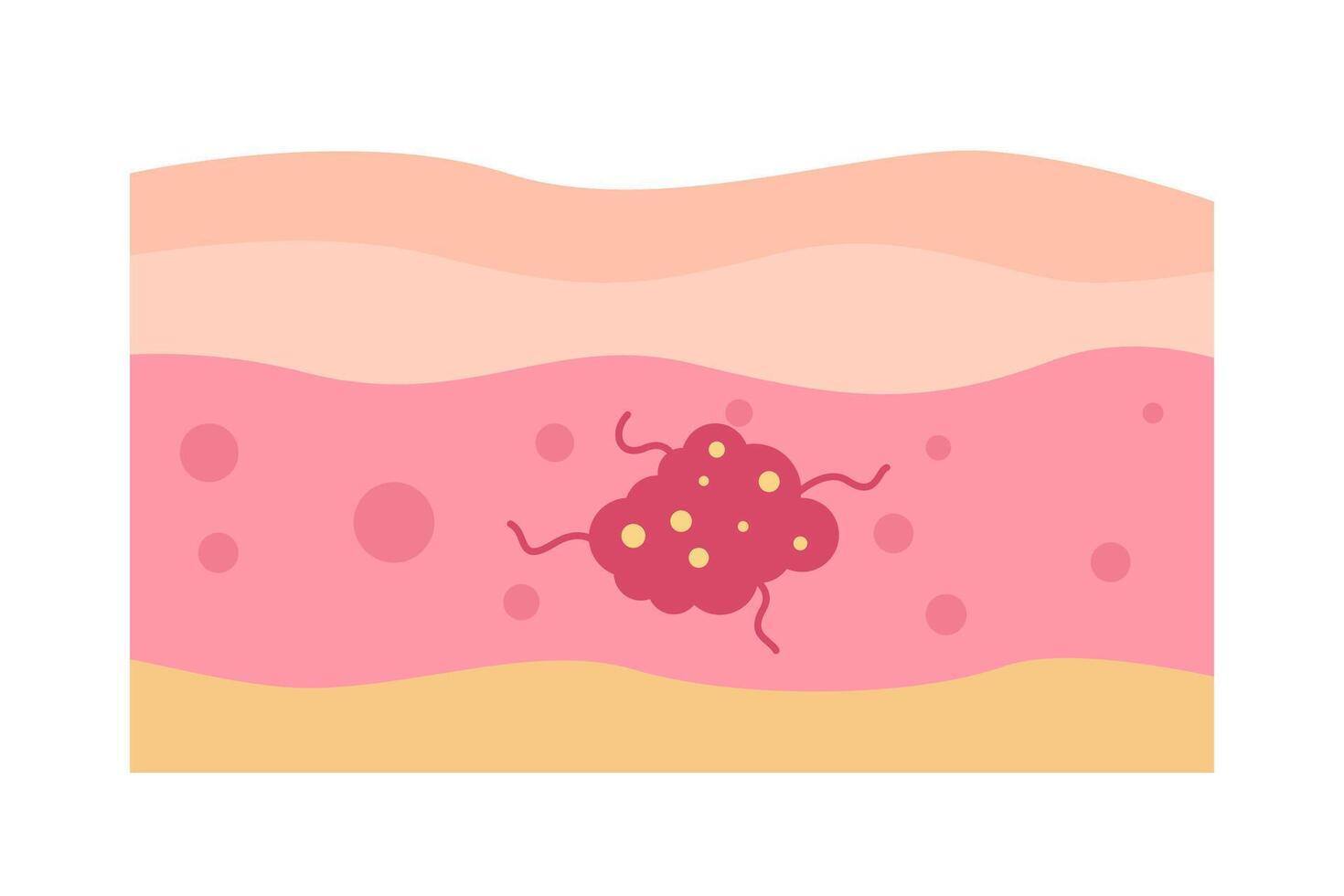 cancer tumor disease concept vector