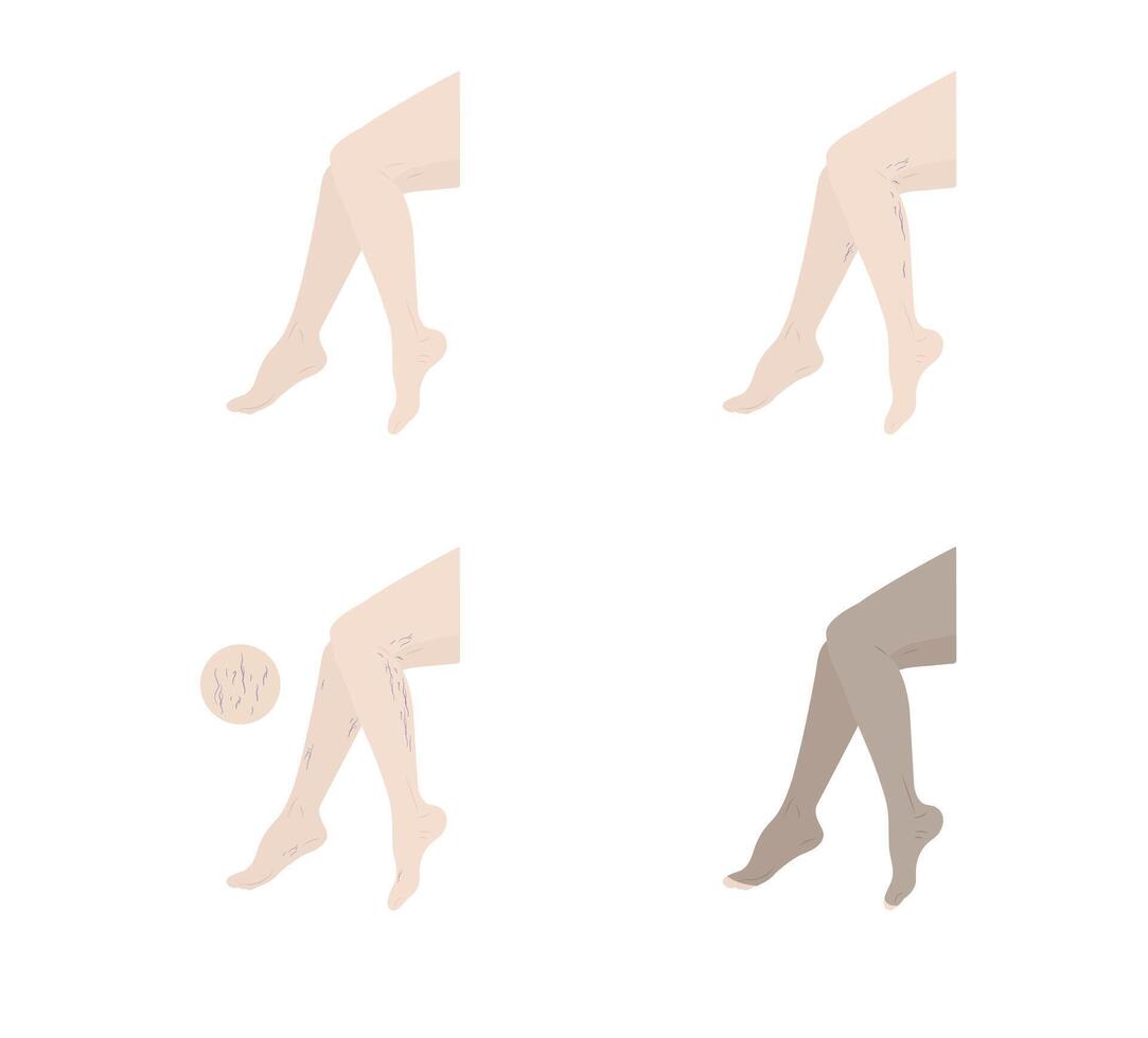 varicose veins period on human leg isolated on background vector