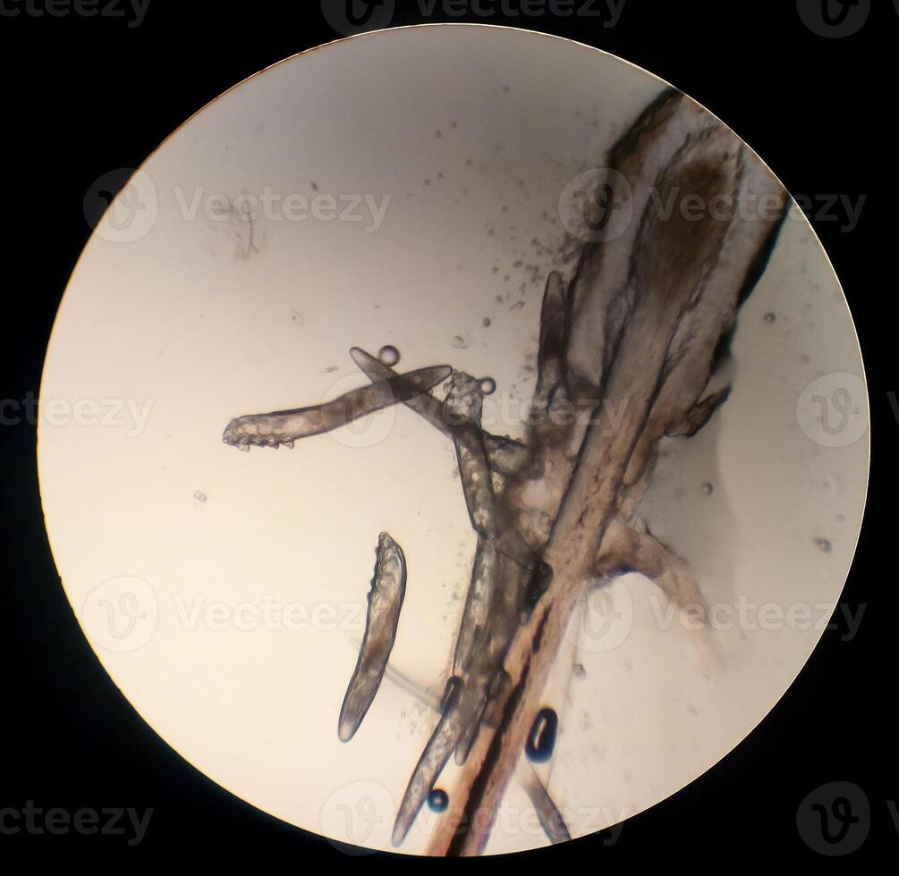 Demodex folliculorum - parasitic mite on the eyelashes of a human eye photo