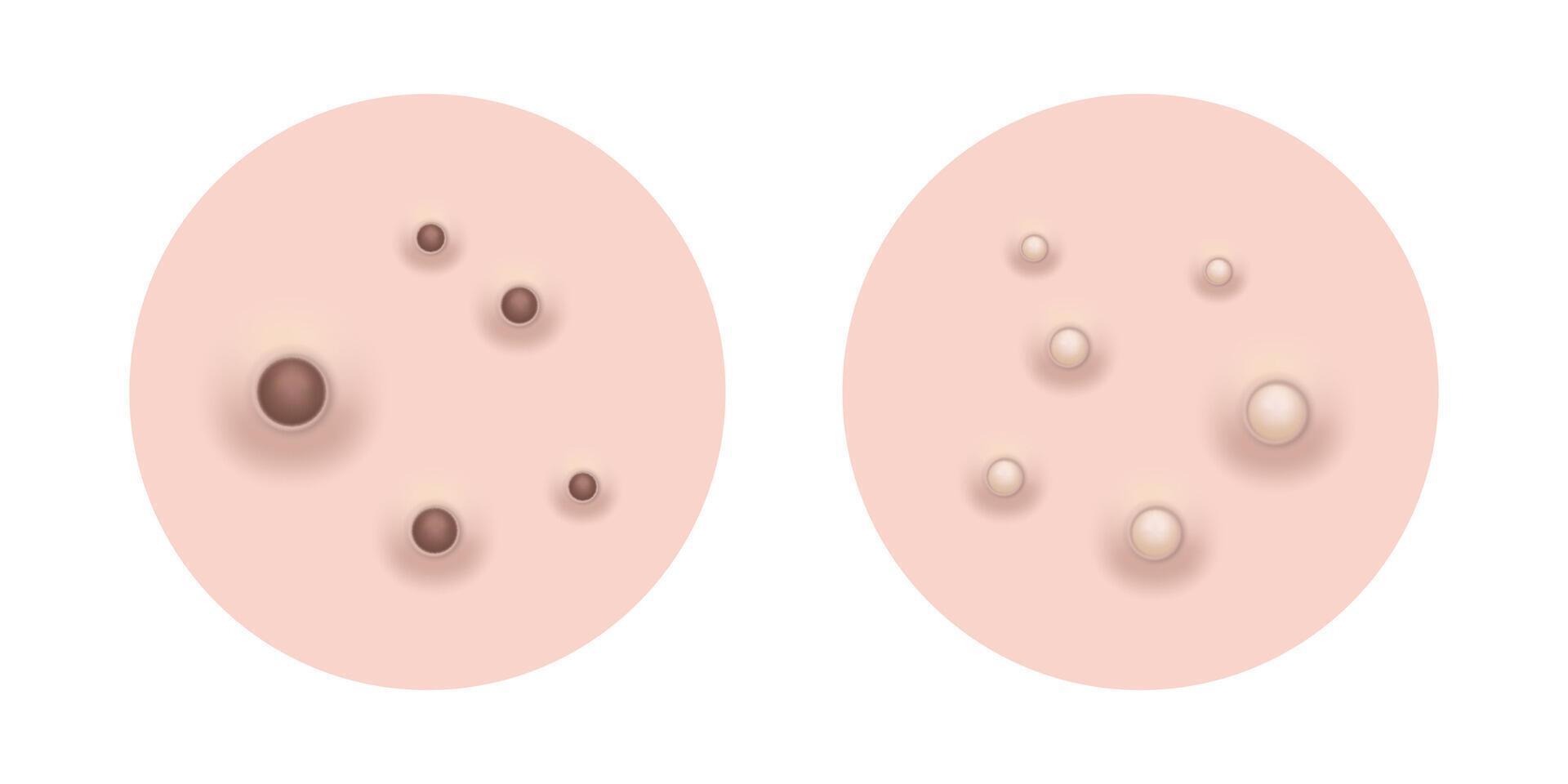 Blackheads and whiteheads Acne skin pimple, illustration vector