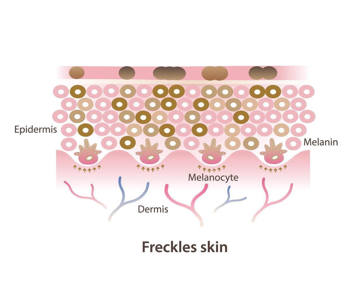 Cross section of freckles on skin layer illustration isolated on white background. Freckles are small flat brown spots on skin, types of hyperpigmentation, ephelides, solar lentigines. vector