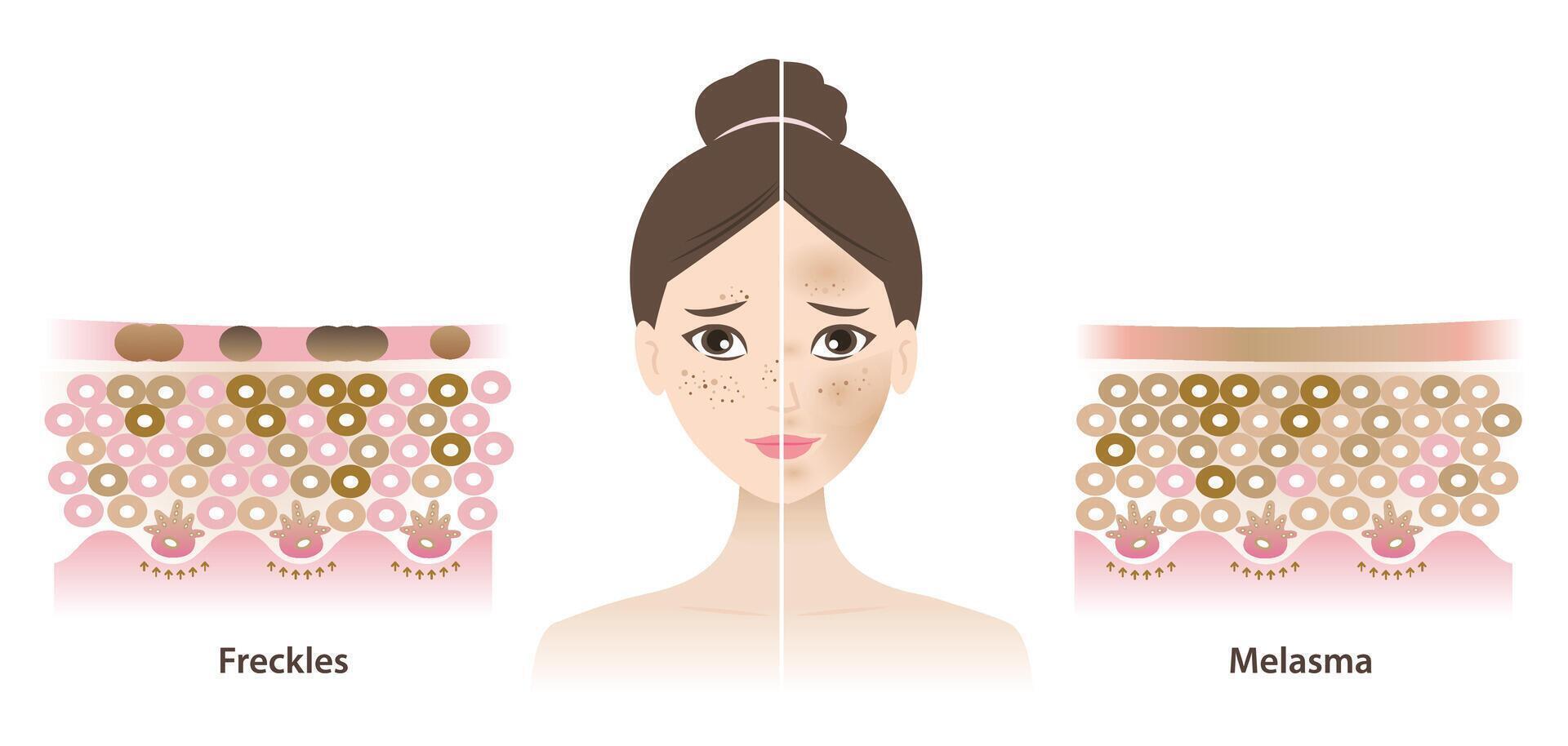 Infographic of freckles and melasma skin on woman face illustration. Comparison of hyperpigmentation, small flat brown spots and brown, blue gray patches on skin layer. Skin care concept. vector