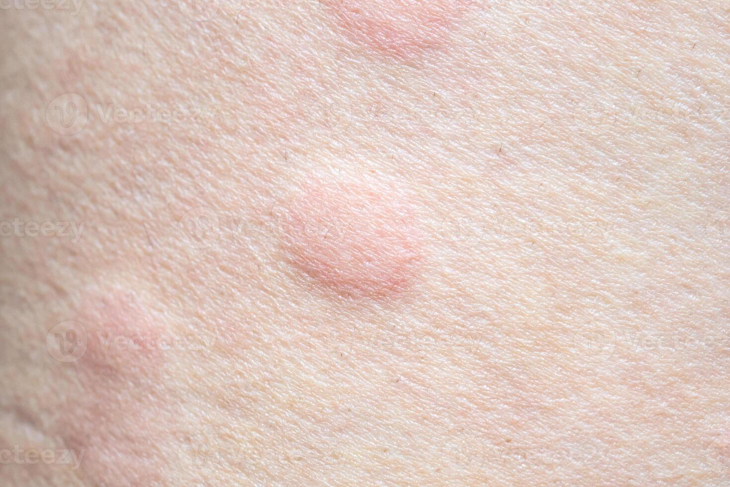 Skin allergy rash dermatitis texture close up photo