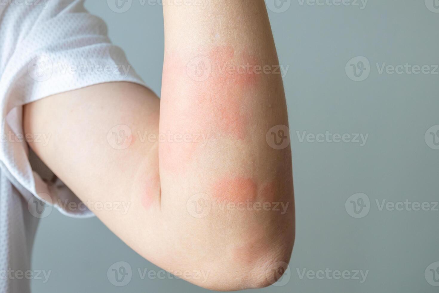 Young asian man itching and scratching on arm from allergic itchy dry skin eczema dermatitis insect bites photo