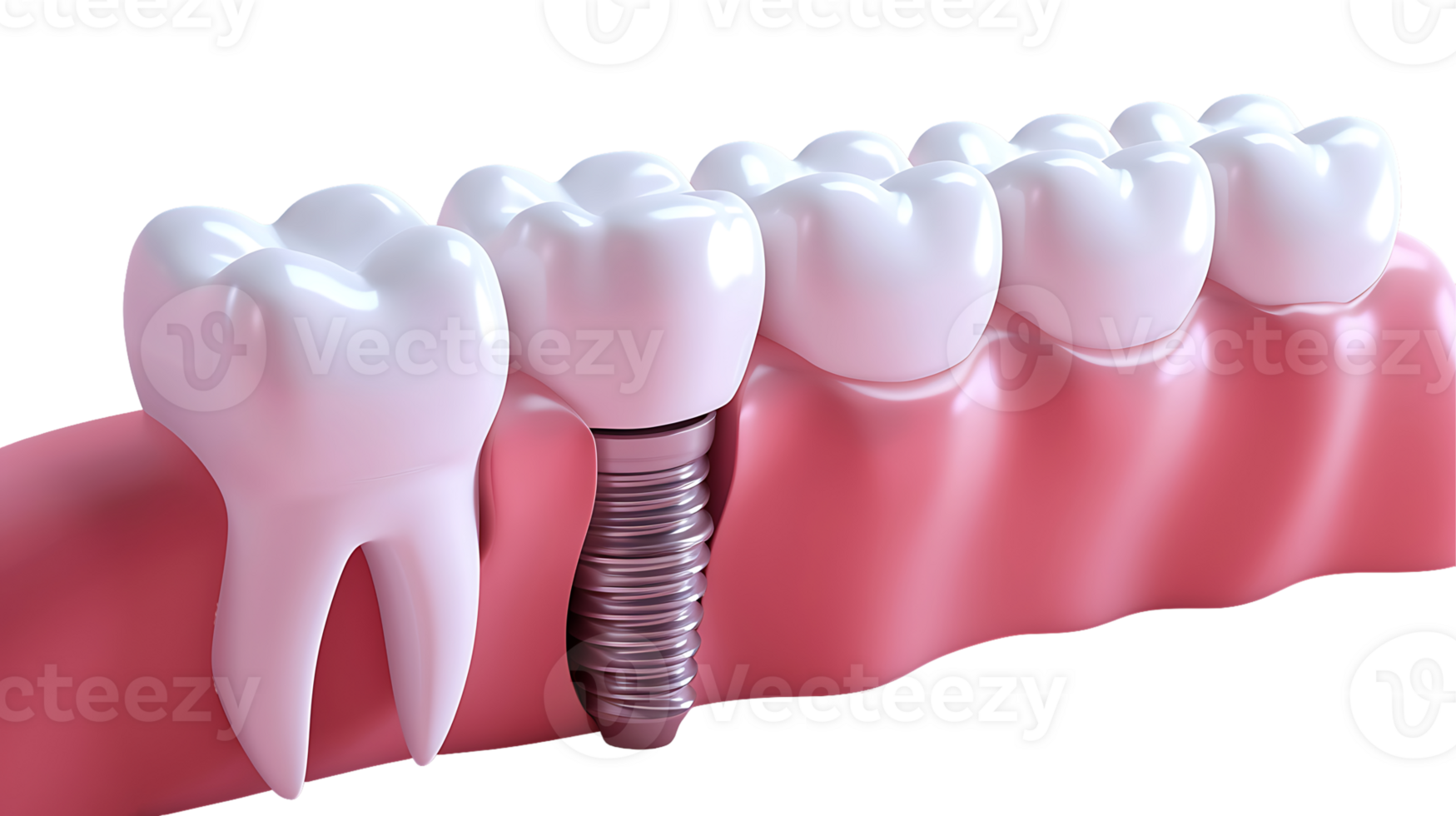 Tooth and dental implants on a transparent background png