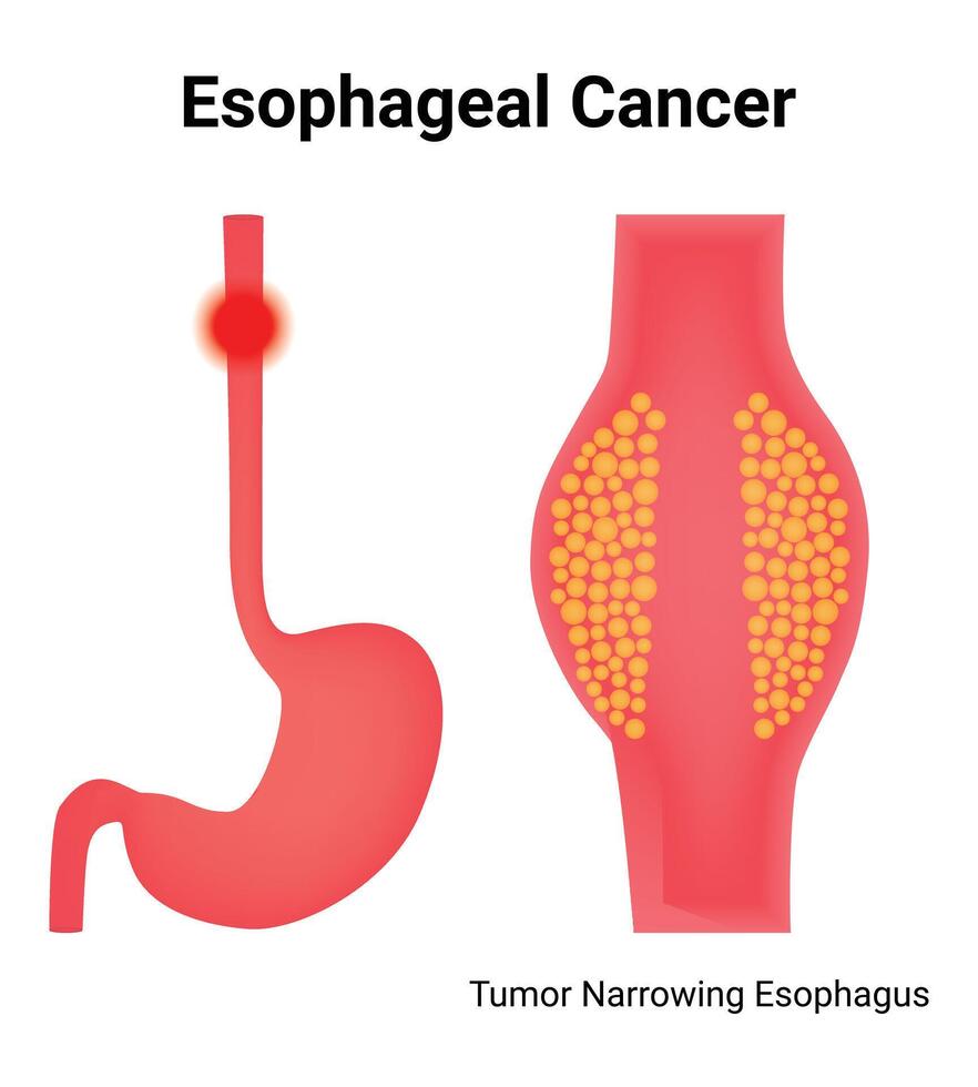 Esophageal Cancer Science Design Illustration Diagram vector