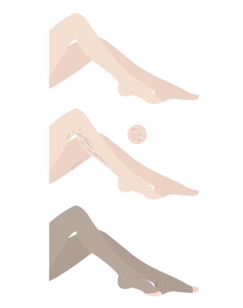 varicose veins period on human leg isolated on background vector