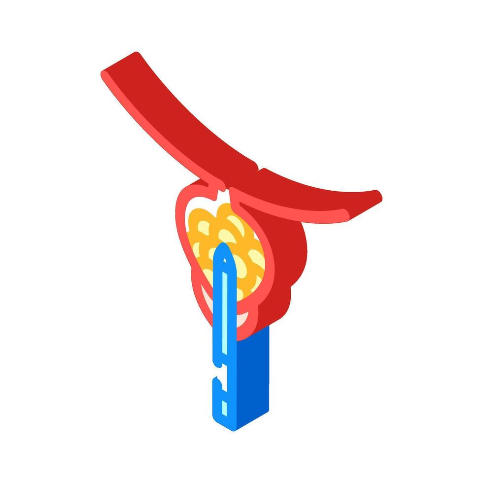 transurethral resection prostate surgery isometric icon illustration vector