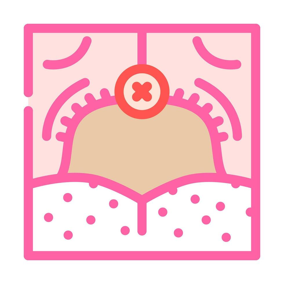 uvulopalatopharyngoplasty surgery color icon illustration vector