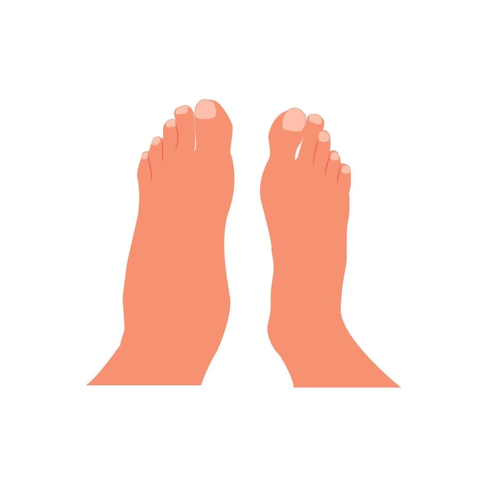 Swollen foot, normal foot. Before, after. Healthcare illustration. vector