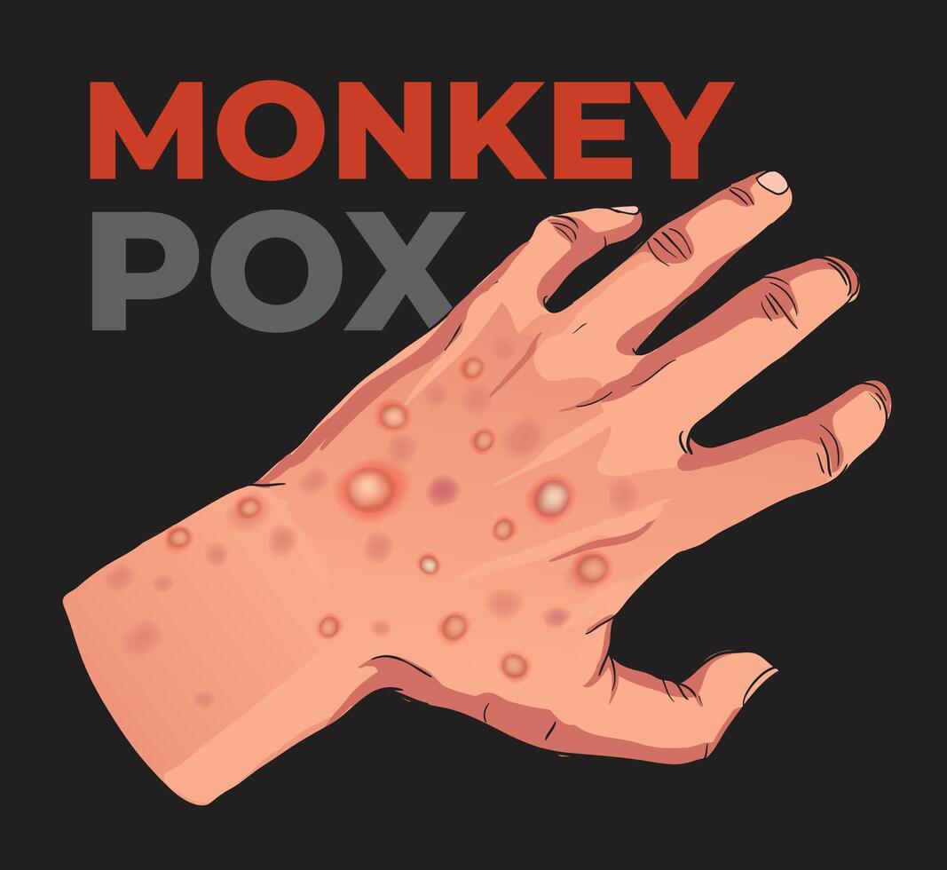 illustration of monkey pox rash in hand vector