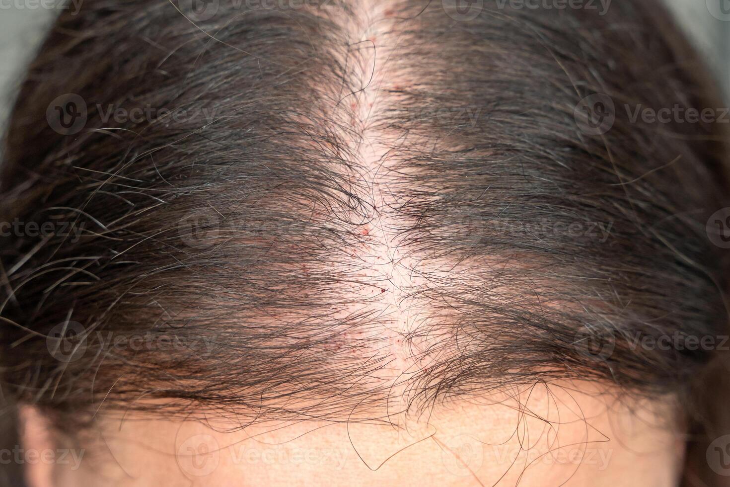Close-up view of the head with traces of blood from injections after mesotherapy, treatment of alopecia concept photo