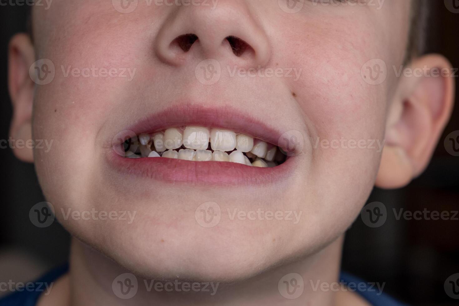 Child's crooked teeth. Young man showing crooked growing teeth. photo