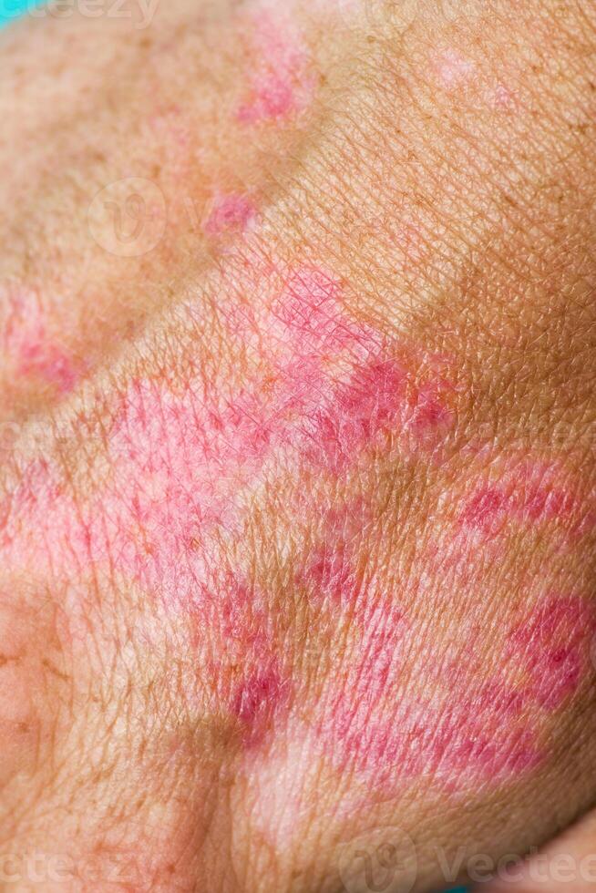 Burns of hand, wounds. Hand with sunburn. Type of burn photo