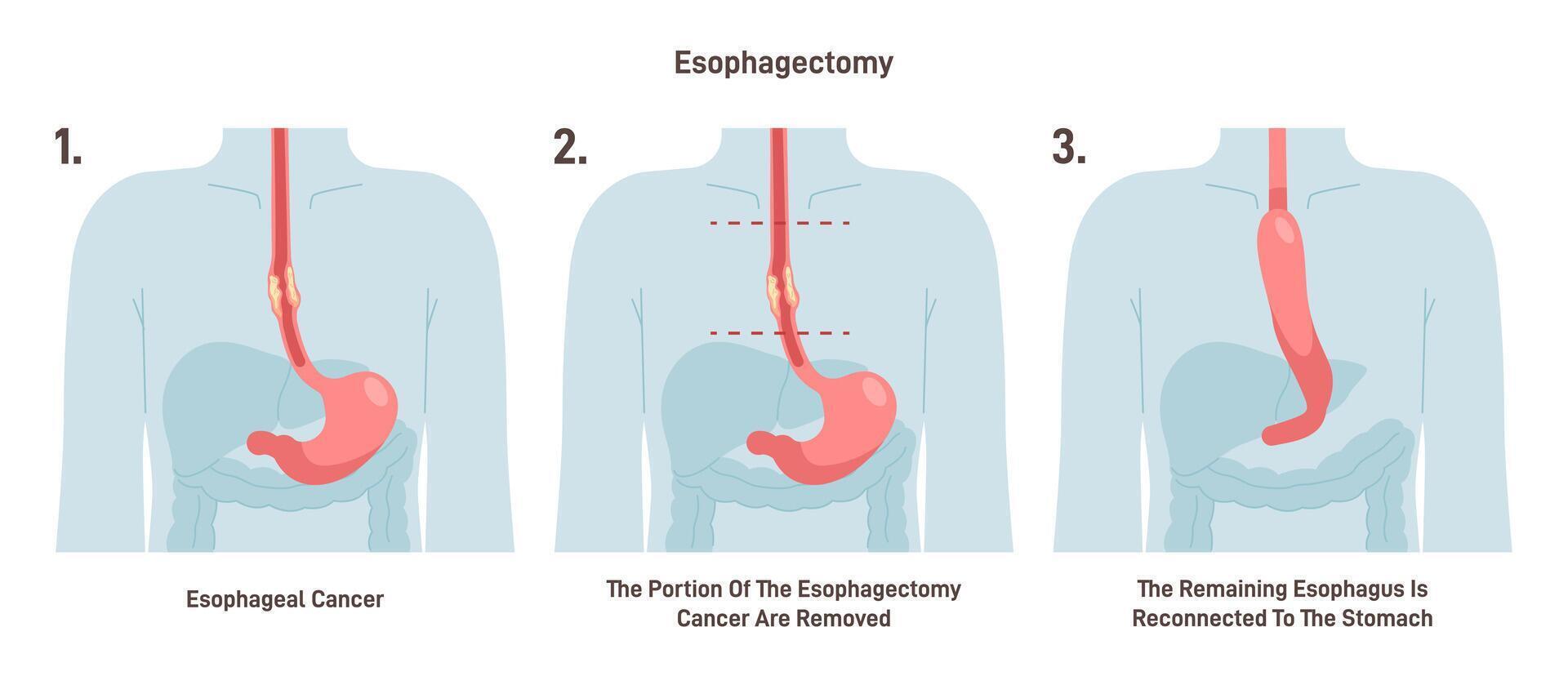 Esophagectomy. Partial excision of the esophagus. Surgical procedure vector