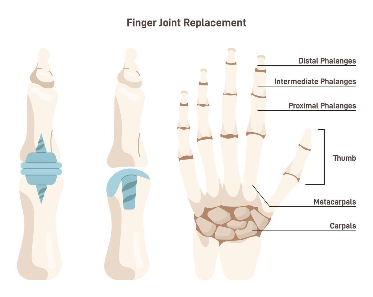 Joint implantation. Injured or distracted human joint replaced with artificial vector
