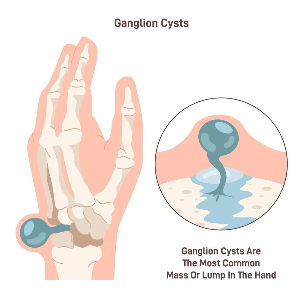 Ganglion cyst. Fluid-filled lump under the skin of a wrist or hand. Synovial vector