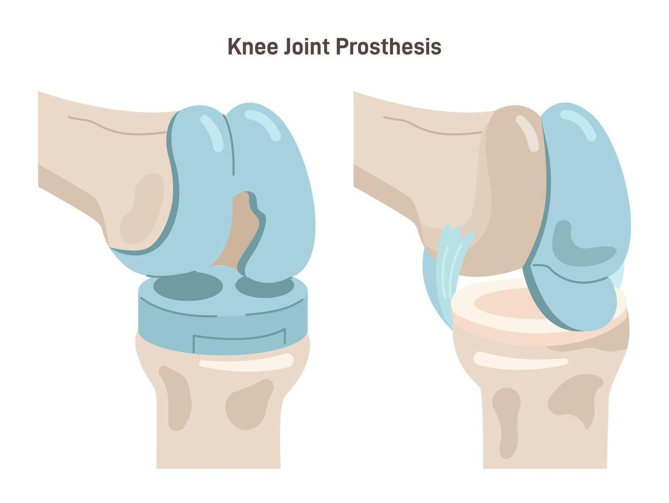 Joint implantation. Injured or distracted human joint replaced with artificial vector