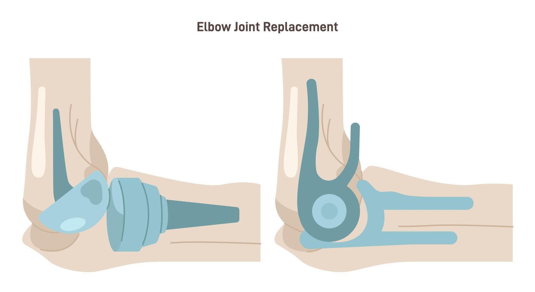 Joint implantation. Injured or distracted human joint replaced with artificial vector