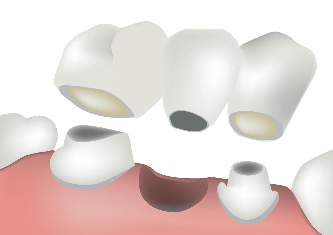 Dental bridge being applied to teeth with a missing tooth vector