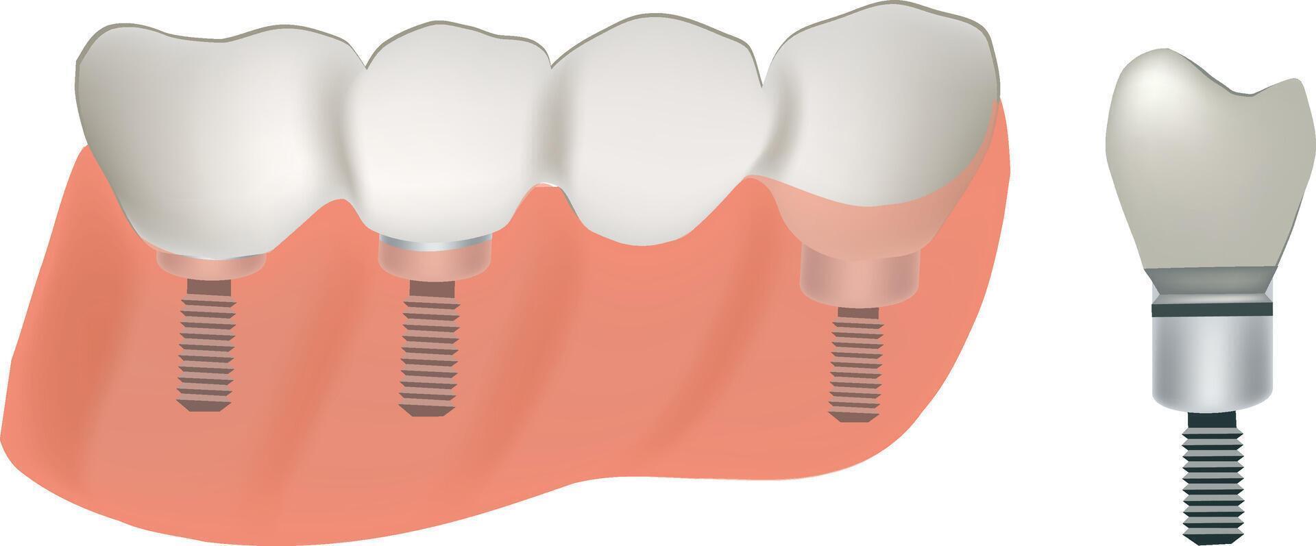 Dental bridge supported by three implants replacing teeth vector