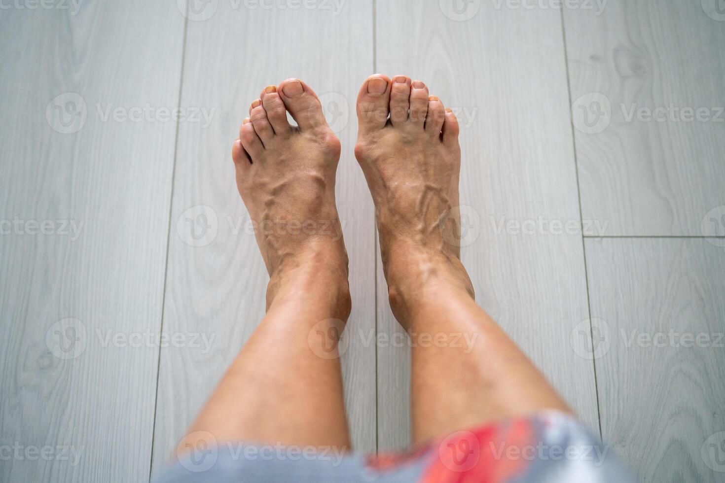 Senior woman varicose bare feet with valgus deformity. Activity pain, orthopaedics need, bunion photo