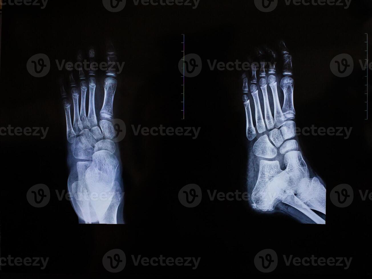X-ray of the foot in two projections photo