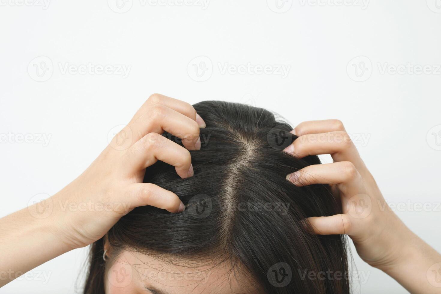 A woman has problems with hair and scalp,she has dandruff from allergic reactions to shampoos. and hair conditioner photo