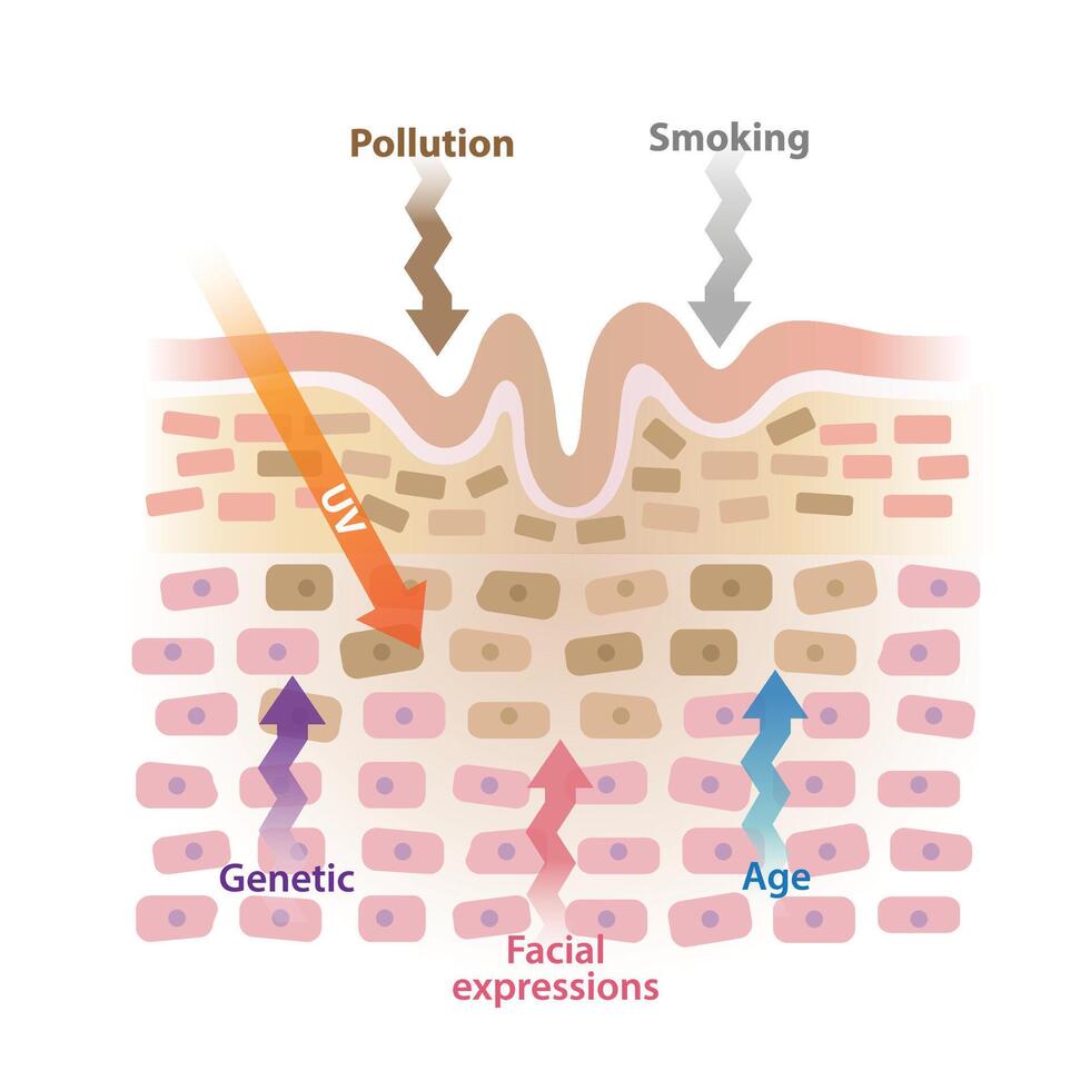 Cause of wrinkles on skin layer illustration isolated on white background. Age, ultraviolet radiation, smoking, pollution, facial expressions, genetic causes lines and creases to form on skin. vector