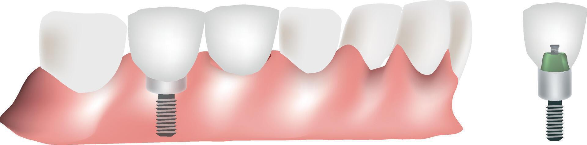 Dental implantation process replacing missing tooth with crown vector