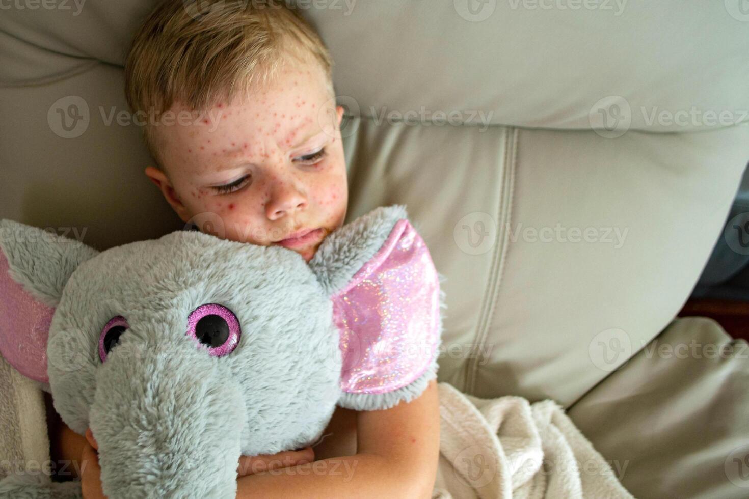 Natural vaccination. Contagious disease. photo