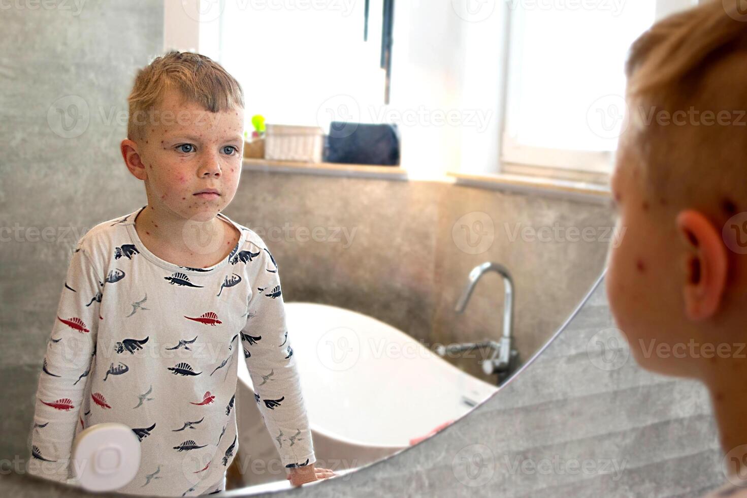 Varicella virus or Chickenpox bubble rash on child photo