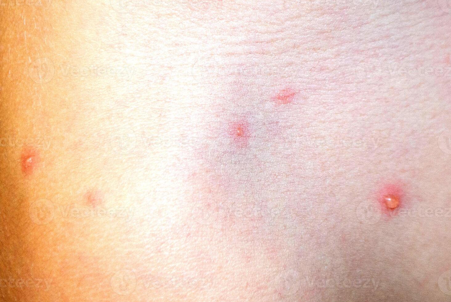 Varicella virus or Chickenpox bubble rash on child photo