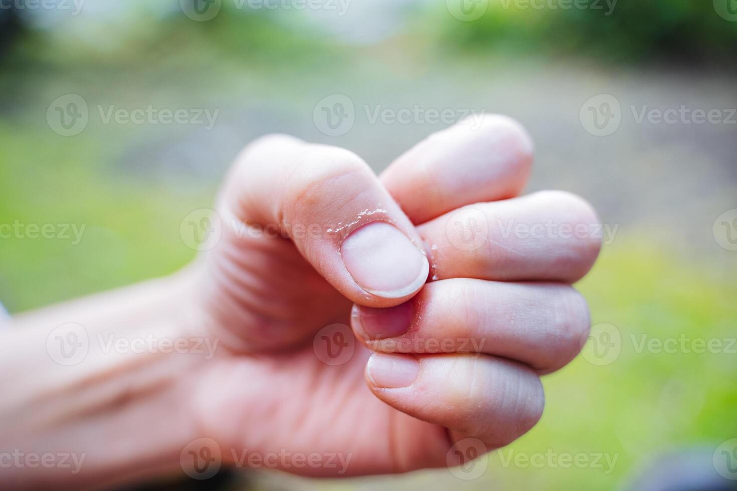 Cuticles on the fingers close-up, problem with the skin on the hands, dry nail areas, lack of manicure, no nail polish. photo