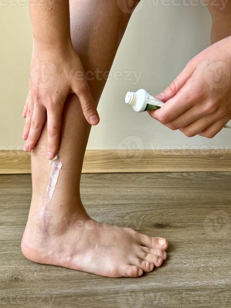 Applying moisturizing cream by hand to a healing scar on the right ankle with tube cream photo