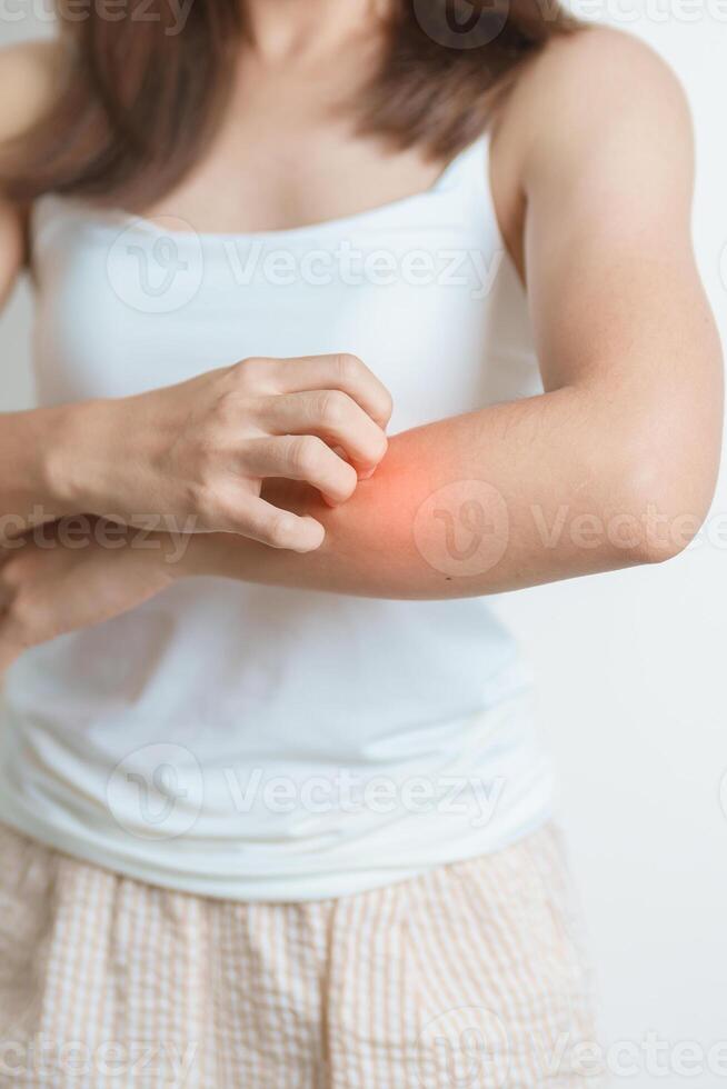woman itching and scratching itchy arm. Sensitive Skin Allergic reaction to insect bite, food, drug dermatitis. Dermatology, Leprosy day, Systemic lupus erythematosus, Allergy symptoms and rash Eczema photo
