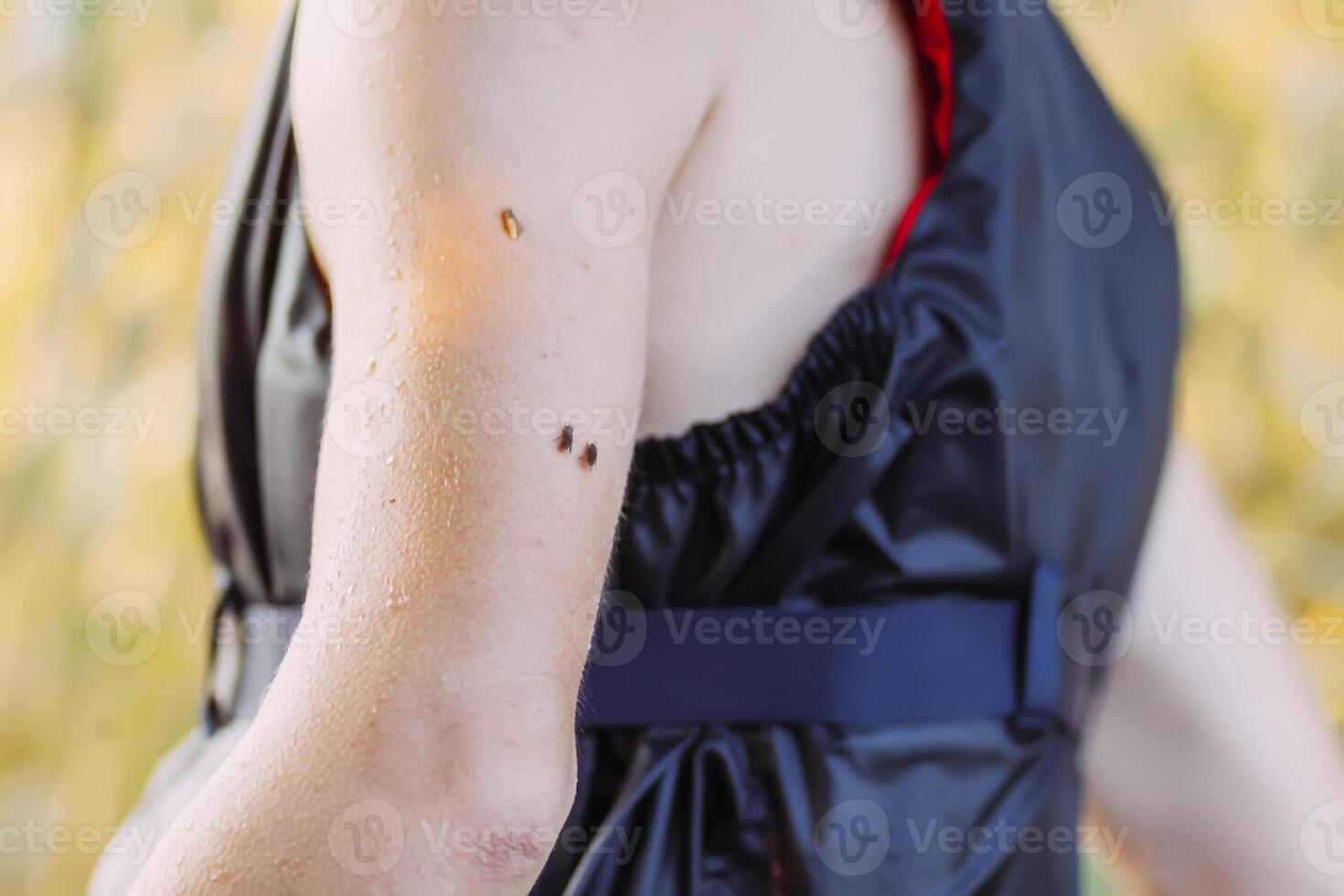Insect bite on human skin photo