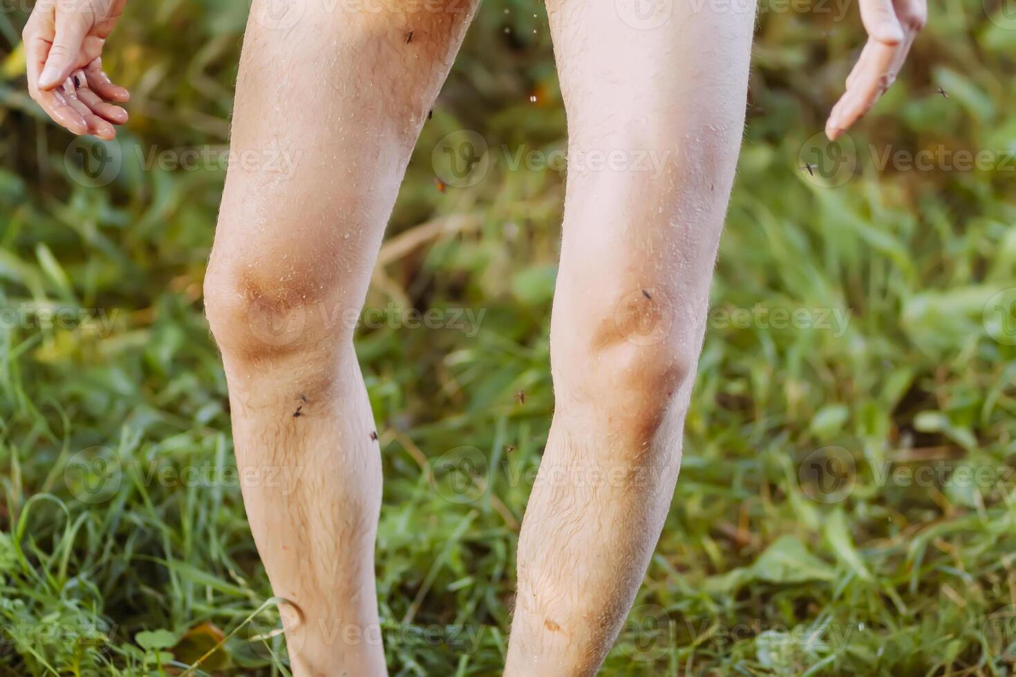 Insect bite on human skin photo