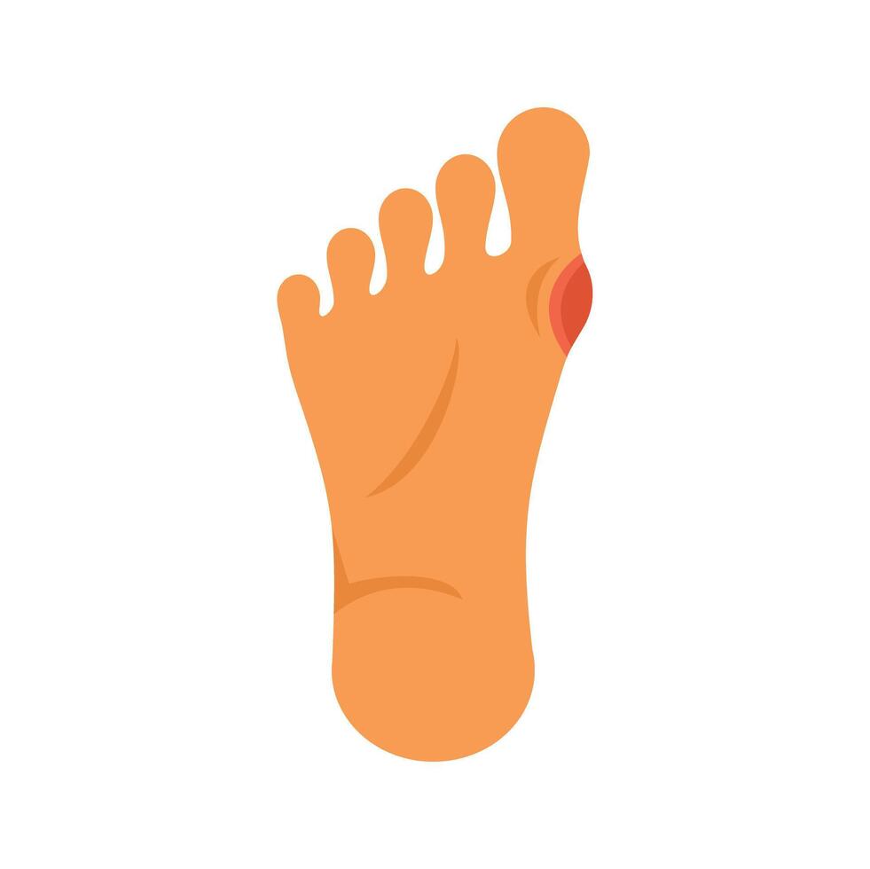 Human foot experiencing painful hallux valgus condition vector