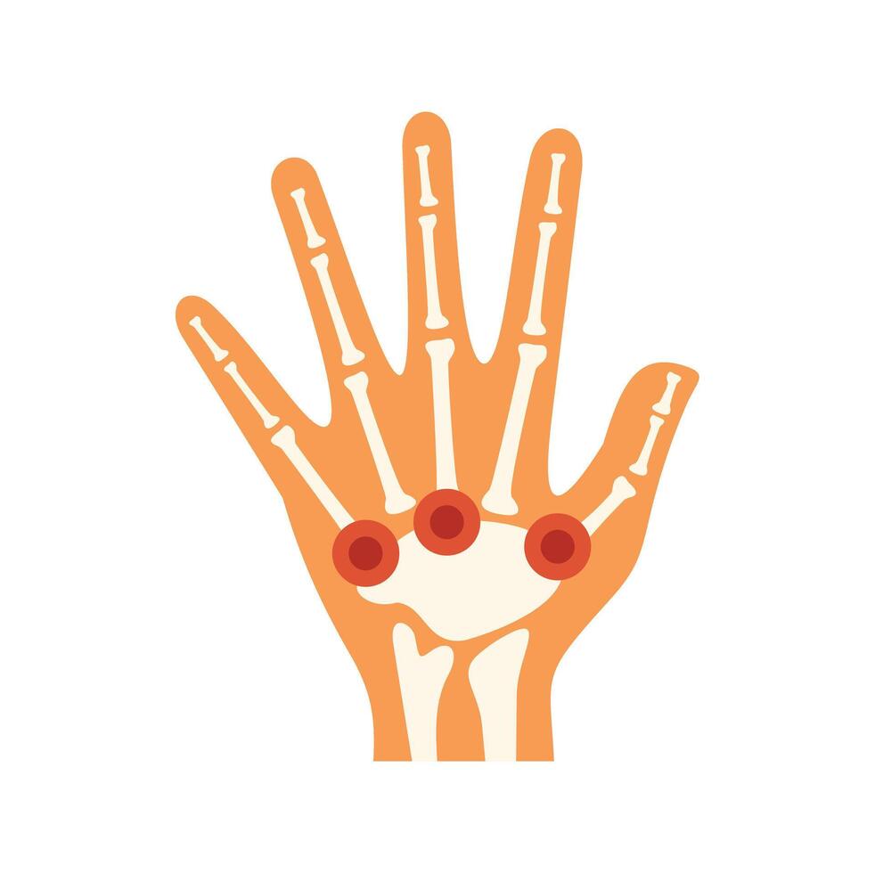 Human hand showing rheumatoid arthritis symptoms vector