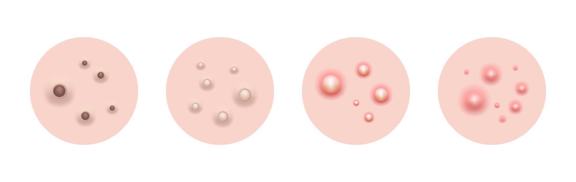 Acne skin pimple, illustration vector
