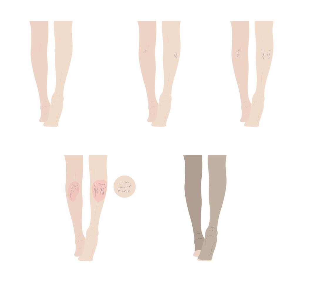 varicose veins period on human leg isolated on background vector