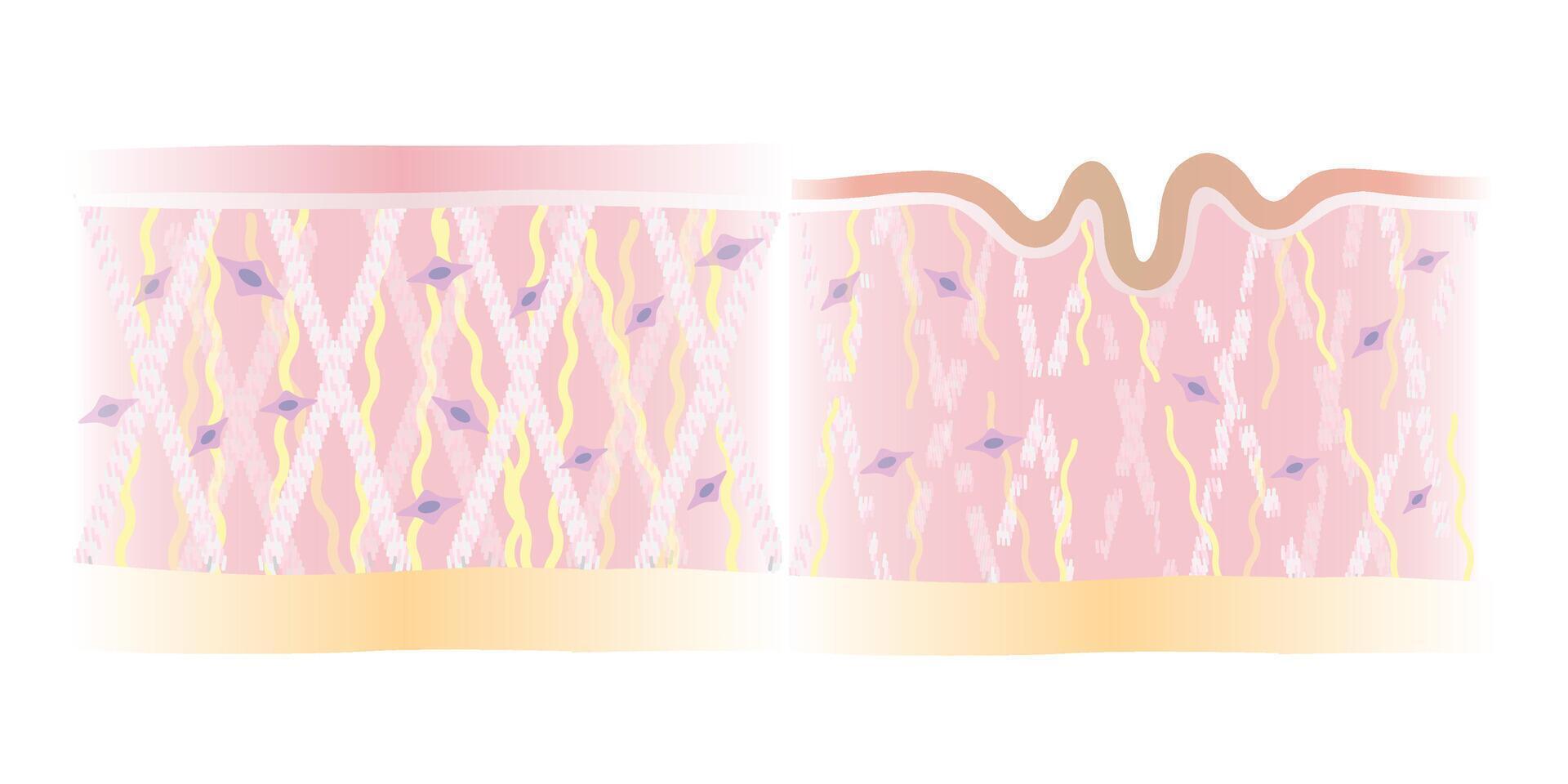 Comparison of healthy and wrinkled structure skin layer illustration isolated on white background. Cross section of intact and broken collagen, elastin fibers, fibroblasts. Skin care and beauty. vector