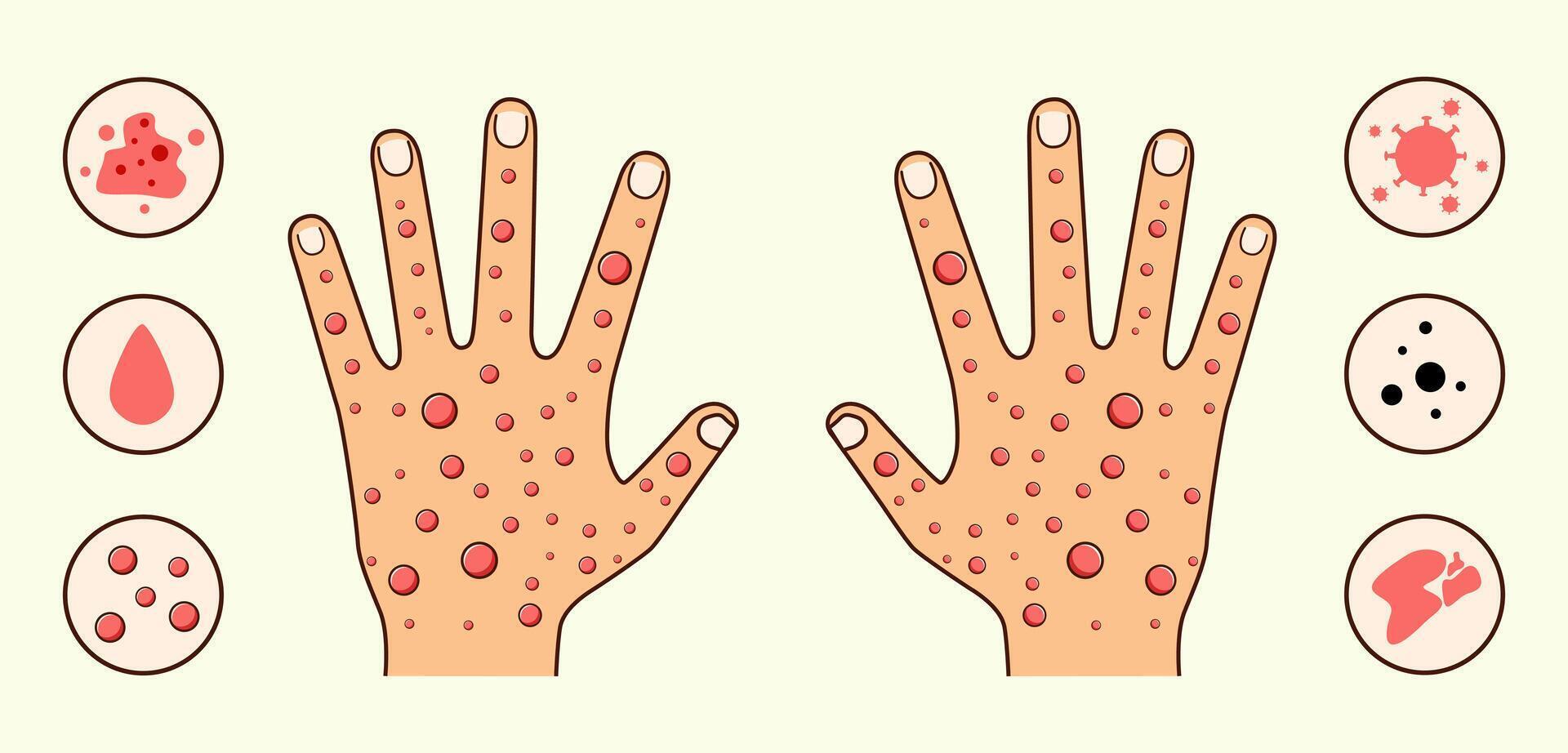 Illustration of Two Hands with Red Spots and There are Explanatory Circles on the Right and Left Sides of the Hands vector