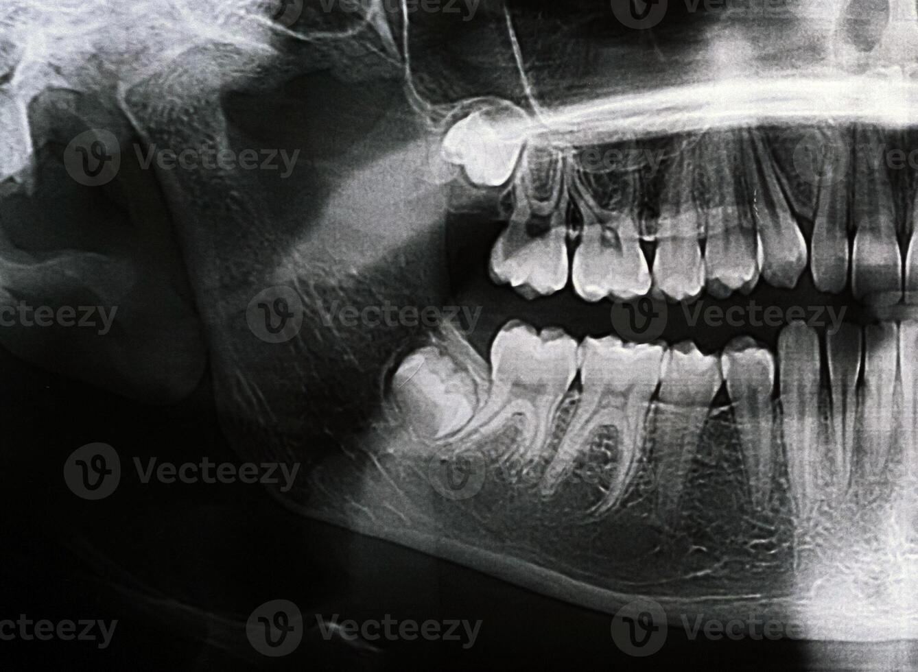 Panoramic X-ray of the jaw. X-ray of the teeth of a 12-year-old girl photo