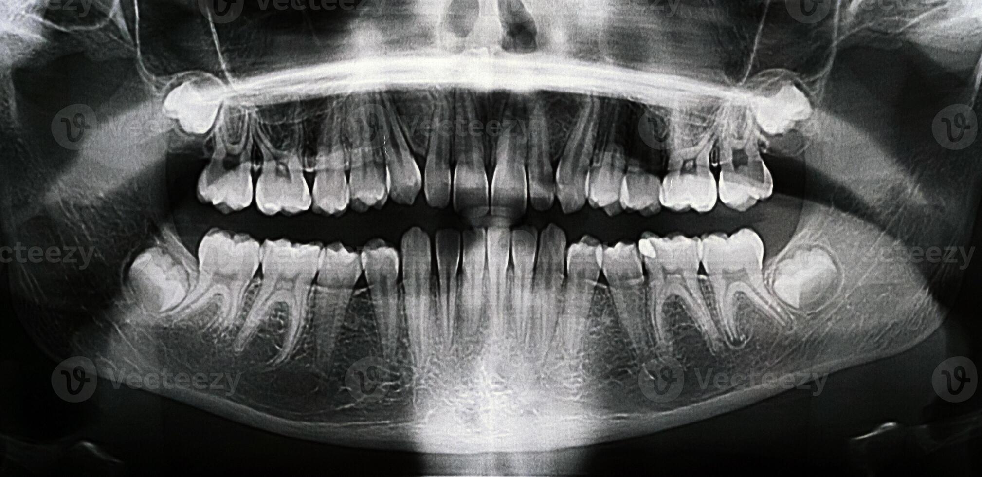Panoramic X-ray of the jaw. X-ray of the teeth of a 12-year-old girl photo