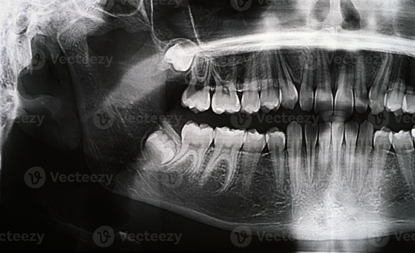 Panoramic X-ray of the jaw. X-ray of the teeth of a 12-year-old girl photo