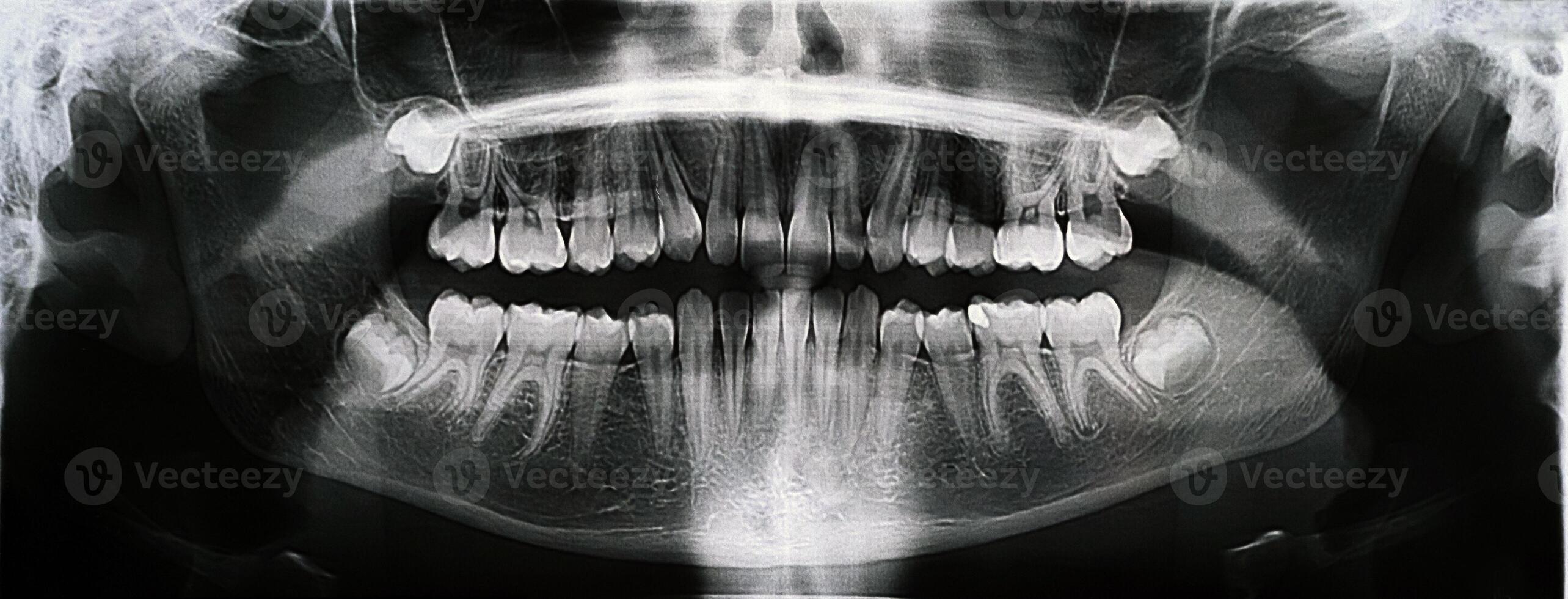 Panoramic X-ray of the jaw. X-ray of the teeth of a 12-year-old girl photo