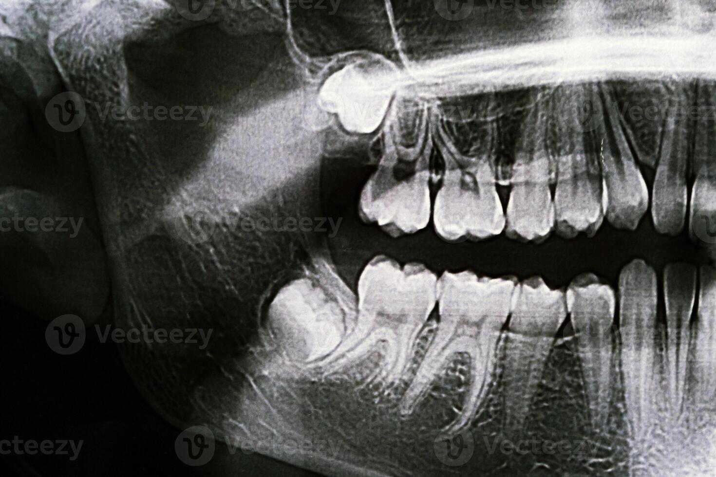 Panoramic X-ray of the jaw. X-ray of the teeth of a 12-year-old girl photo